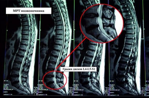 Могат ли рентгеновите снимки да имат херния на гръбнака?