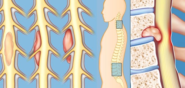 Рак на гръбнака: класификация на това заболяване, неговите симптоми и лечение