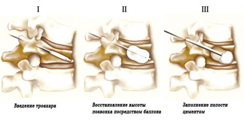 Причини и признаци на лечение на гръдна кифоза