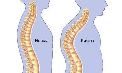 Причини и признаци на лечение на гръдна кифоза