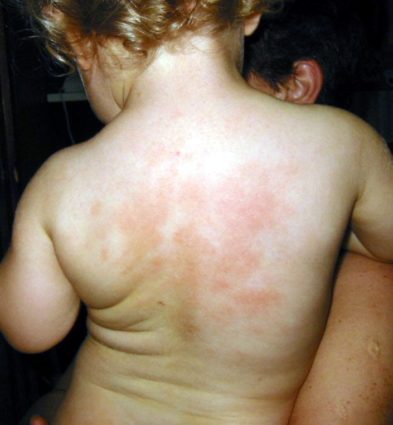 Причини и симптоми на обрив на гърба на дете