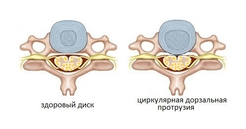 Кръгли издатъци на гръбните дискове L3-L4, L4-L5, L5-S1