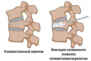Компресионна фрактура на гръбначния стълб (прешлен): причини, симптоми, първа помощ и методи на лечение