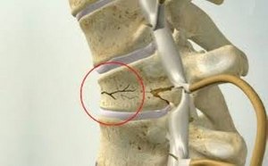Компресионна фрактура на гръбначния стълб (прешлен): причини, симптоми, първа помощ и методи на лечение