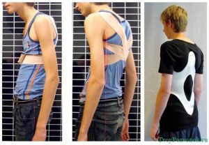 Степени и признаци на kyphoscoliosis на гръбначния стълб