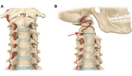 Степени на остеохондроза на цервикалния гръбначен стълб