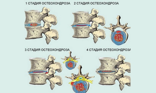 Степени на остеохондроза на цервикалния гръбначен стълб
