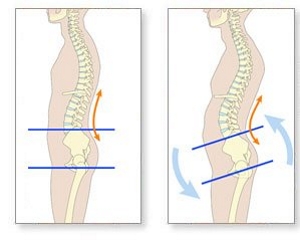 Диагностика и лечение на лордоза на гръбначния стълб