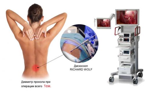 Ефективно отстраняване на херния на гръбнака с лазер
