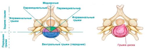Ефикасността на ендоскопското отстраняване на херния на гръбначния стълб