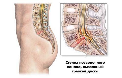 Ефикасността на ендоскопското отстраняване на херния на гръбначния стълб