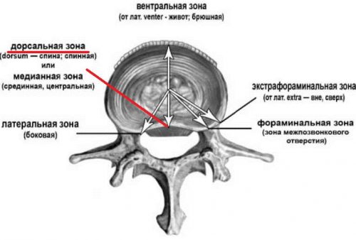 Характеристики на херния на гръбначния диск l5 s1