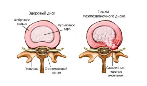 Характеристики на проявата на младежка остеохондроза