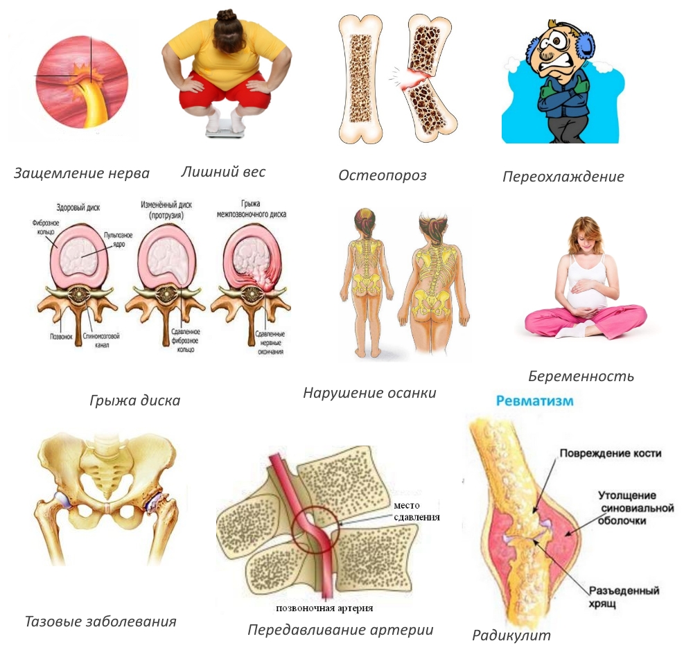 Характеристики на проявлението на синдрома на лумбоскалгия