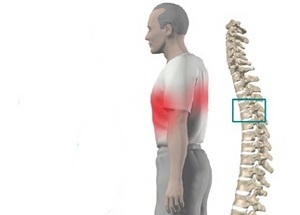 Херния на гръдната част на гръбнака: причини, симптоми и методи на лечение