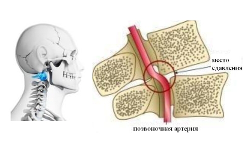 Как треморът на главата се проявява при остеохондроза на шията?