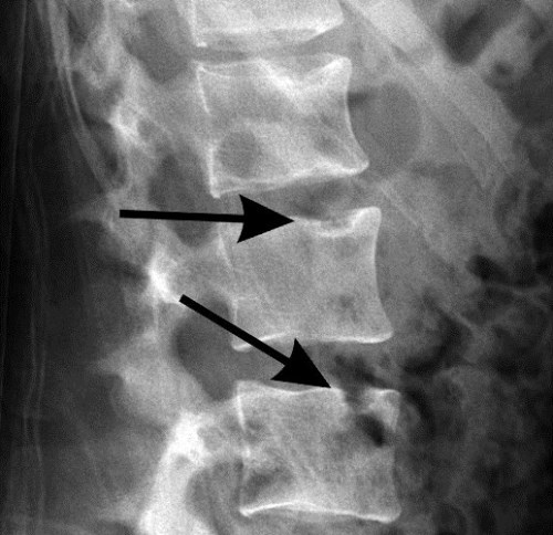 Как да се лекува херния на лумбалната част на гръбначния стълб?