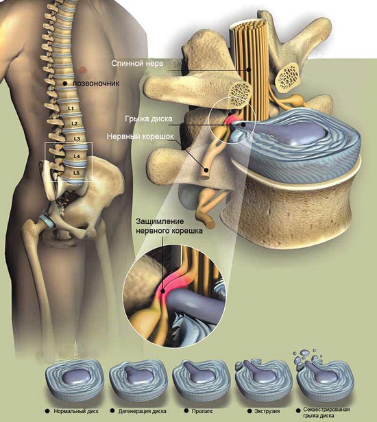 Как да се лекува херния на гръбначния стълб на лумбалния гръбначен стълб?