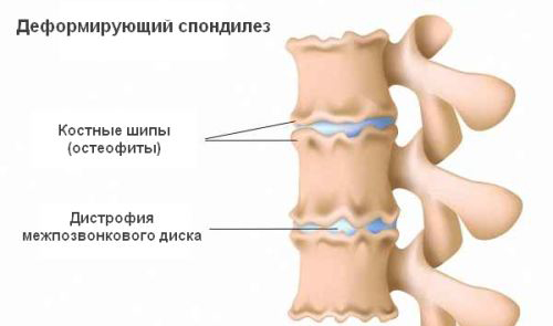 Как да се лекувам правилно спондилозата на гръдния кош?
