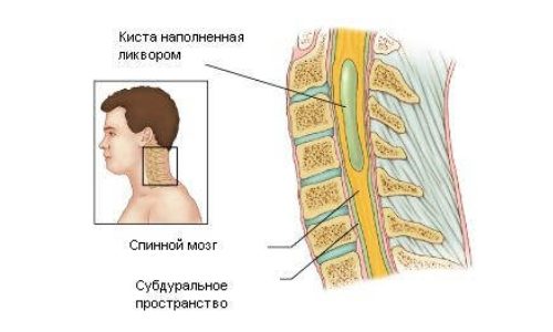 Хидромиелията на гръдния кош и гръбначния стълб