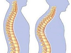Кисосфолиоза на гръдната област: причини, симптоми и лечение на това заболяване