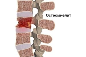 Проява на епидурален абсцес на гръбначния стълб