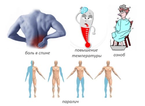 Проява на епидурален абсцес на гръбначния стълб