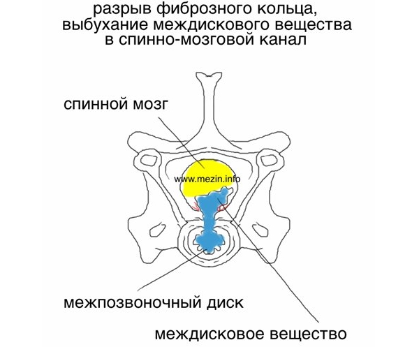 Методи на разширение на гръбначния мозък с херния