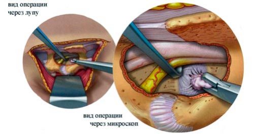 Миелопатия на гръбначния мозък, видове и методи на лечение