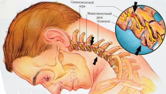 Прилепване на нерва в цервикалната област: причини, симптоми и методи на лечение