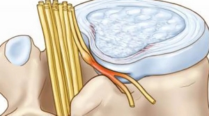 Притискане на нерва в областта на гръдния кош: как се проявява и лекува това състояние?