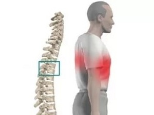 Притискане на нерва в областта на гръдния кош: как се проявява и лекува това състояние?