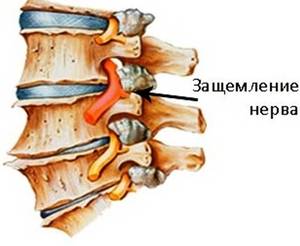 Захващане на нервите в гърба: причини, симптоми и методи на лечение