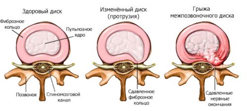 Радикулярна остеохондроза на гръдния и лумбалния гръбначен стълб