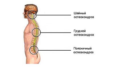 Радикулярна остеохондроза на гръдния и лумбалния гръбначен стълб