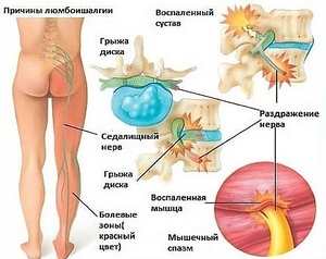 Възпаление на сиатски нерви: причини, симптоми и лечения