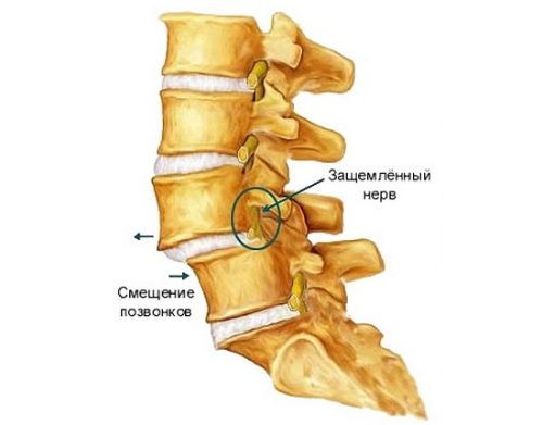 Симптоми на сколиотична деформация на гръбначния стълб