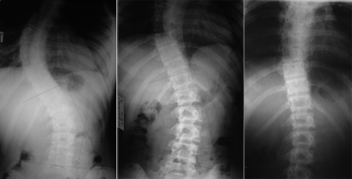 Симптоми на сколиотична деформация на гръбначния стълб