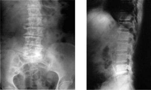 Признаци на спондилоза на лумбосакралния гръбначен стълб