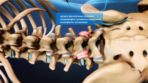 Признаци на спондилоза на лумбосакралния гръбначен стълб