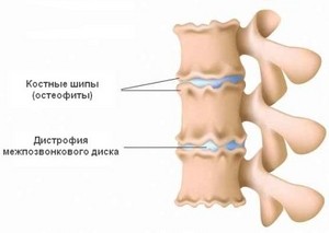 Остеофити на гръбнака: кога и с кого се образуват симптомите и лечението