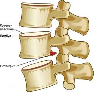 Остеофити на гръбнака: кога и с кого се образуват симптомите и лечението