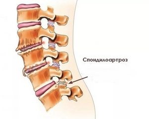 Спондилартроза на шийката на гръбначния стълб: причини, симптоми и методи на лечение