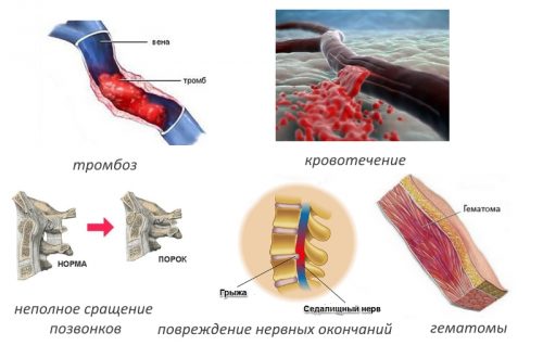 Spondylodesis на лумбалната, цервикалната и гръдната част на гръбначния стълб