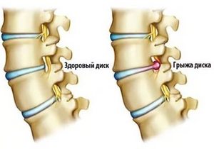 Spondylolisthesis на lumbosacral гръбначния стълб: видове, симптоми и методи за лечение на това заболяване