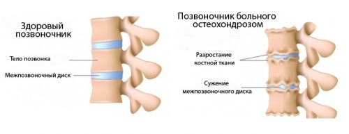Протягане на гръбнака с остеохондроза