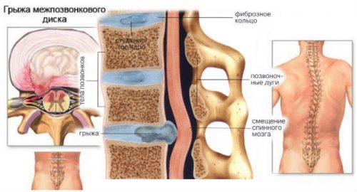 Симптоми и признаци на лечение на гръдната херния