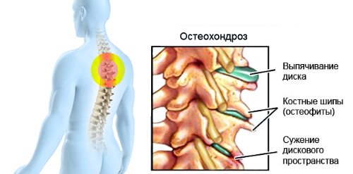Симптоми и признаци на лечение на гръдната остеохондроза