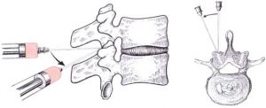 Симптоми и лечение на деформиращата се спондилартроза на гръдния район