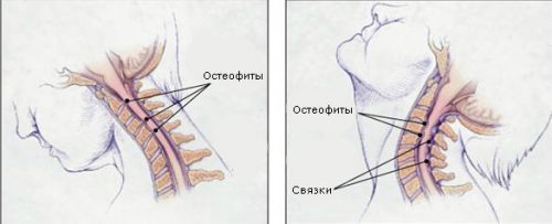 Симптоми и лечение на ревматоиден артрит на гръбначния стълб